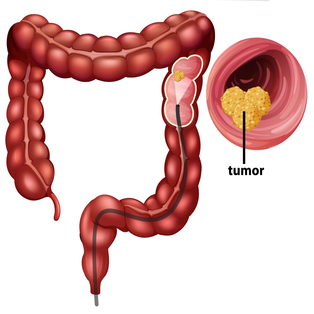 Ilustração de um intestino passando por exame de colonoscopia