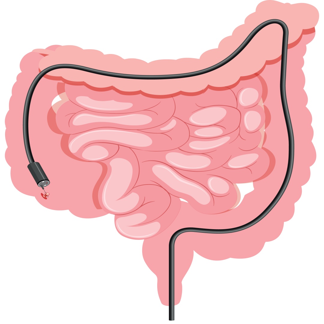 Ilustração de um intestino passando por exame de colonoscopia