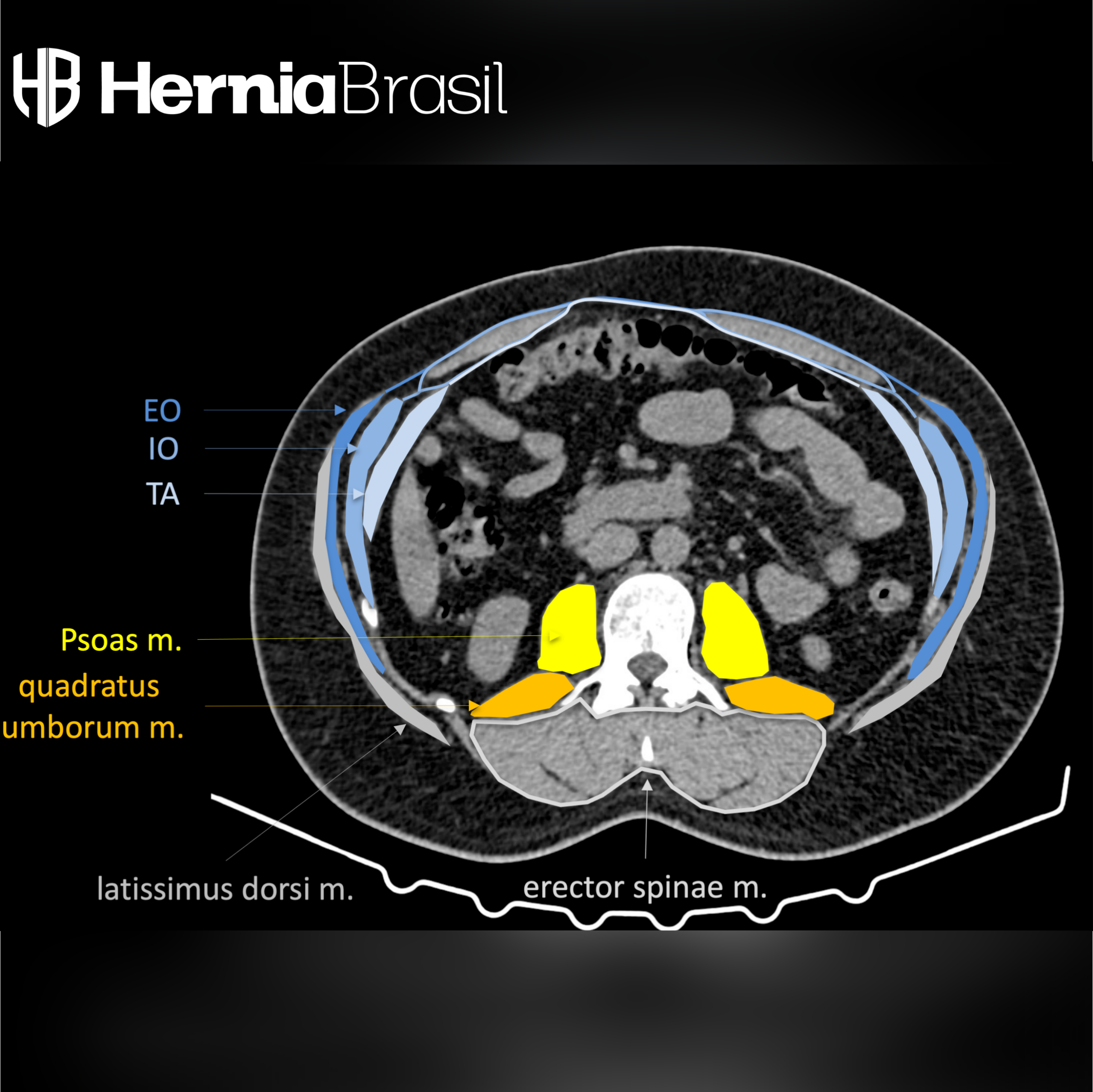 Video-aula sobre a tomografia no planejamento cirúrgico de hérnia abdominal