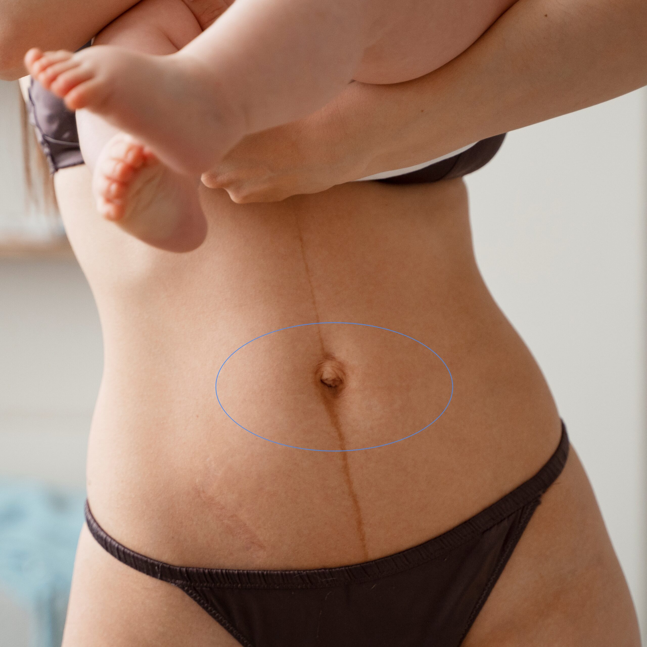 Cirurgia de hérnia inguinal indicações tratamento