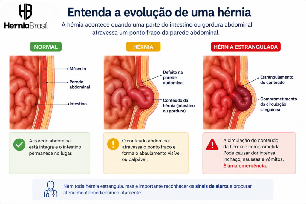 Minha hérnia está piorando? 7 sinais de que é hora de procurar um cirurgião
